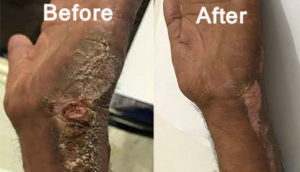 jiyofit-before-after-panchkarma-skin-disease